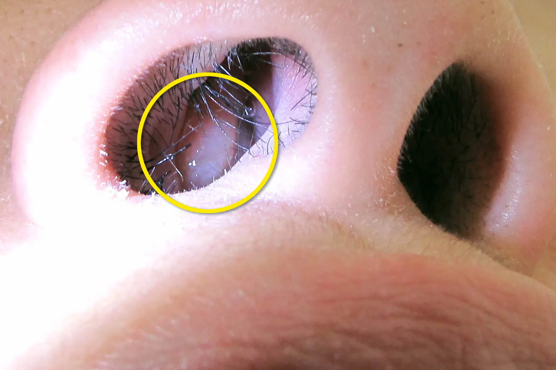 Why Do I Have Nasal Polyps?